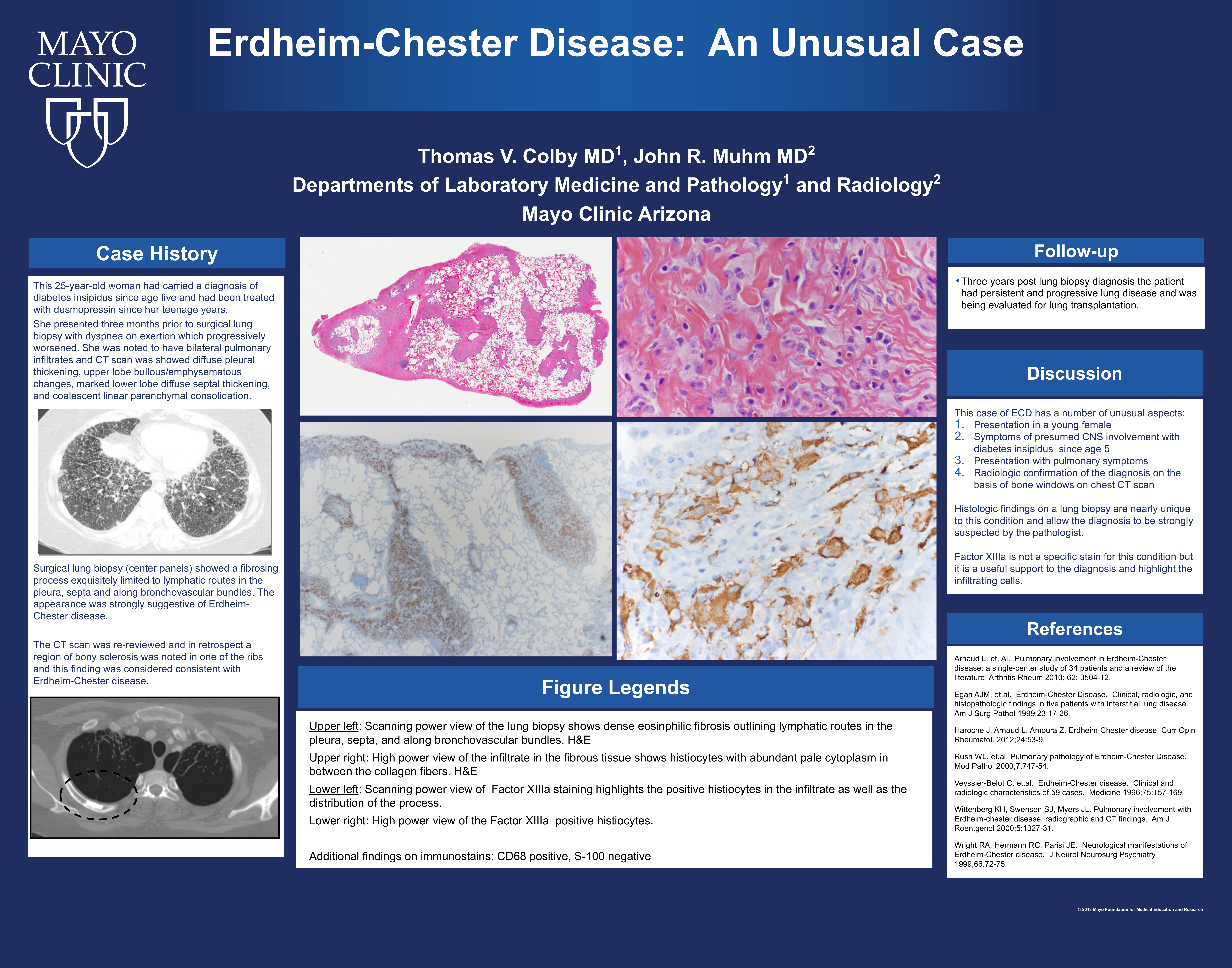 TVC-τελικό-Erdheim-Chester-Disease_Colby_22x28-2